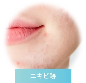 ニキビ跡