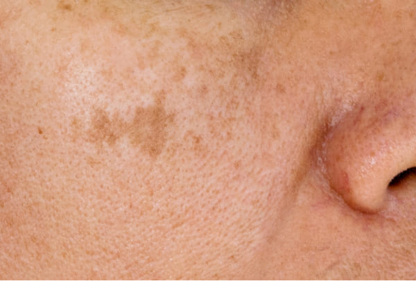 後天性真皮メラノサイトーシス