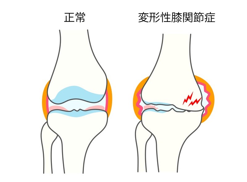変形性膝関節症について