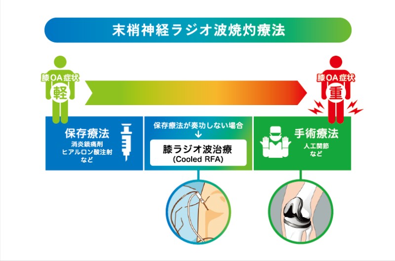 膝ラジオ波治療とは